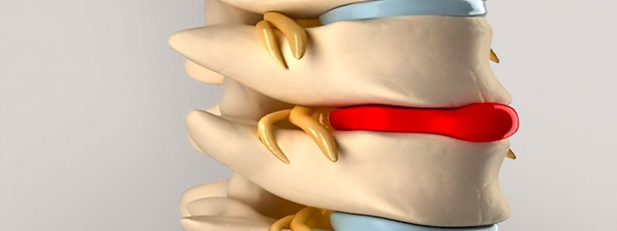 Грыжа межпозвоночного диска