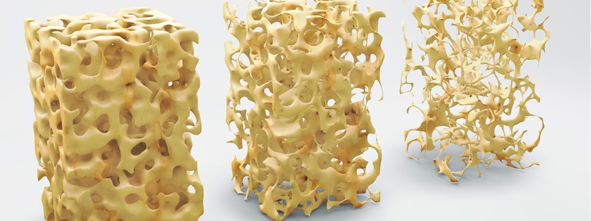 Остеопороз. Остеопения